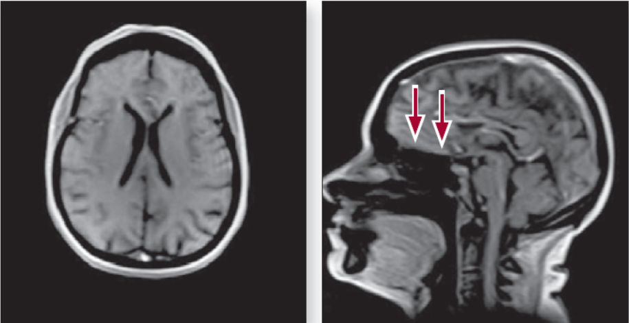 Рисунок 2. МРТ головного мозку пацієнта в сагітальній та аксіальній проекціях (стрілками вказано розширені субарахноїдальні простори)