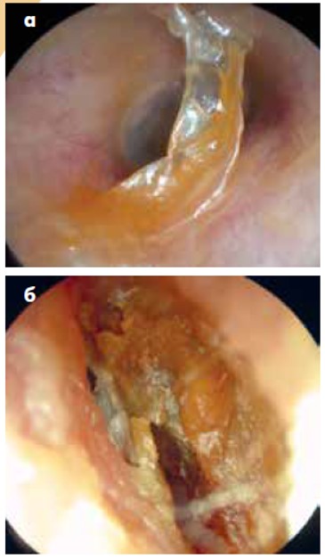 Рис. 1. Епідермально-сірчані нашарування на стінці слухового ходу (а); велика кількість сірки утворює сірчаний корок (б)